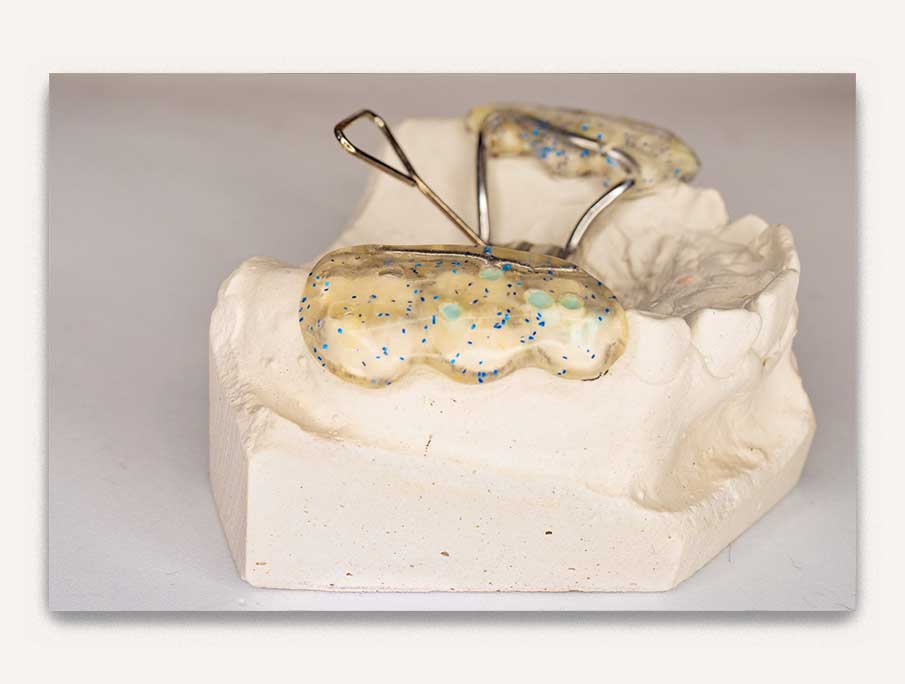 Rapid palatal expansion - orthodontie - valais