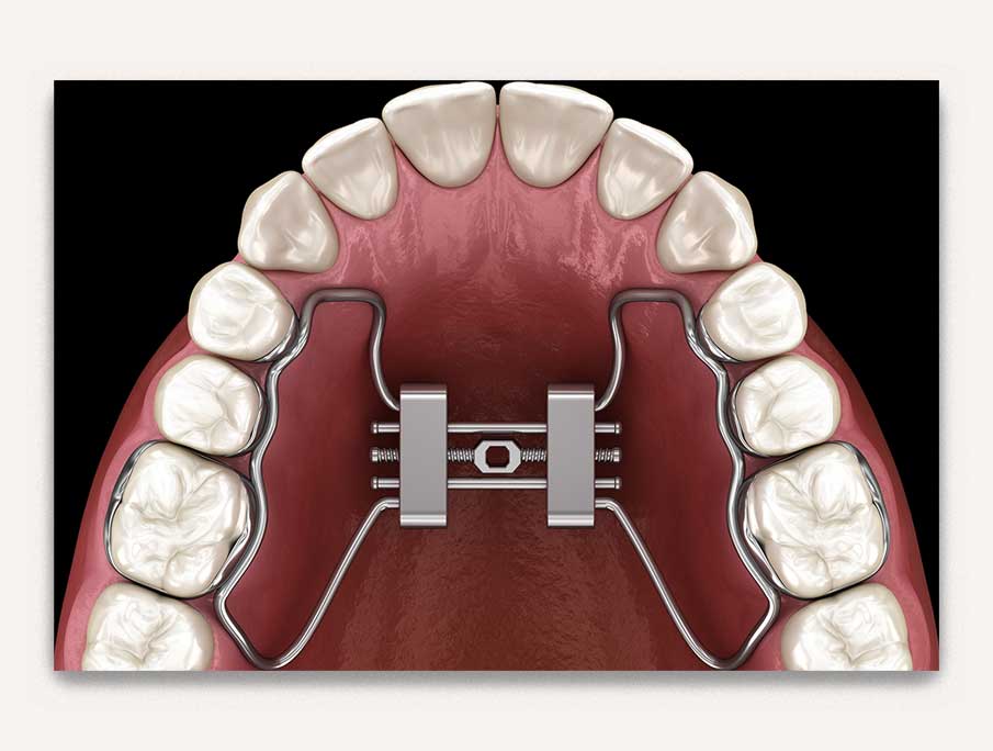 Rapid palatal expansion - orthodontie - valais