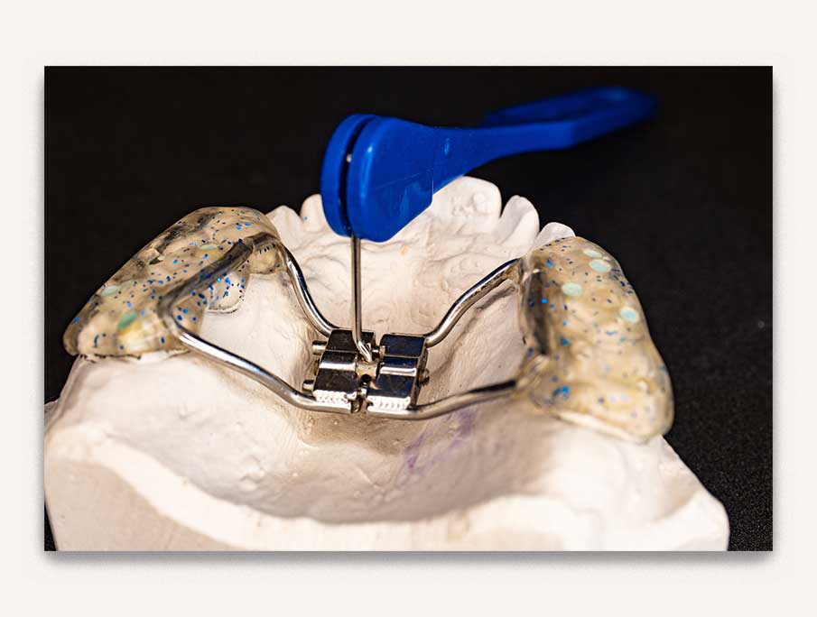 Rapid palatal expansion - orthodontie - valais