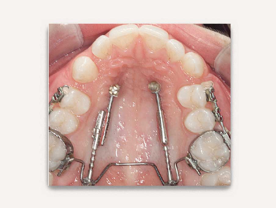 Top-Jet-Distalizer service - Valais