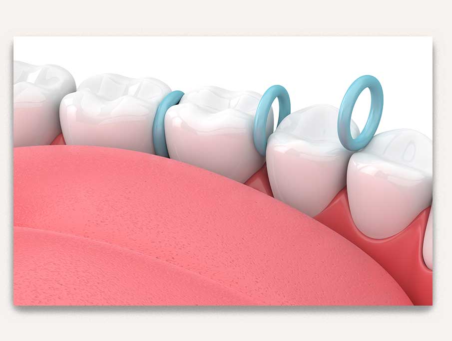 braces - orthodontie valais