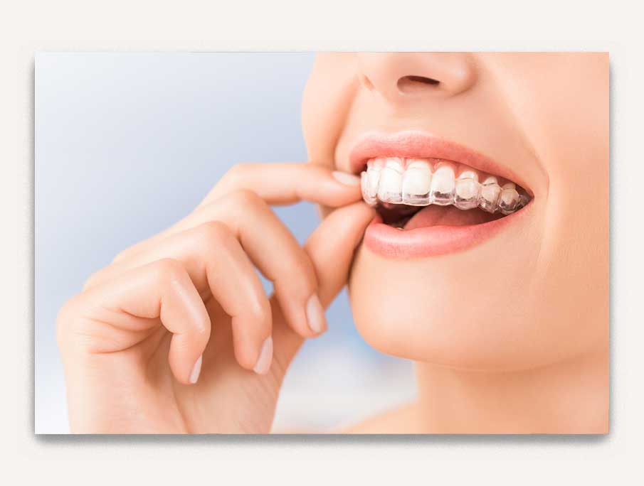 invisalign orthodontiste valais